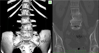 Fusión oblicua-lateral (OLIF) - Morgenstern Institute of Spine